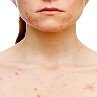 تصویر برای دسته  ضد جوش بدن